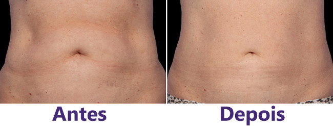 Antes e Depois