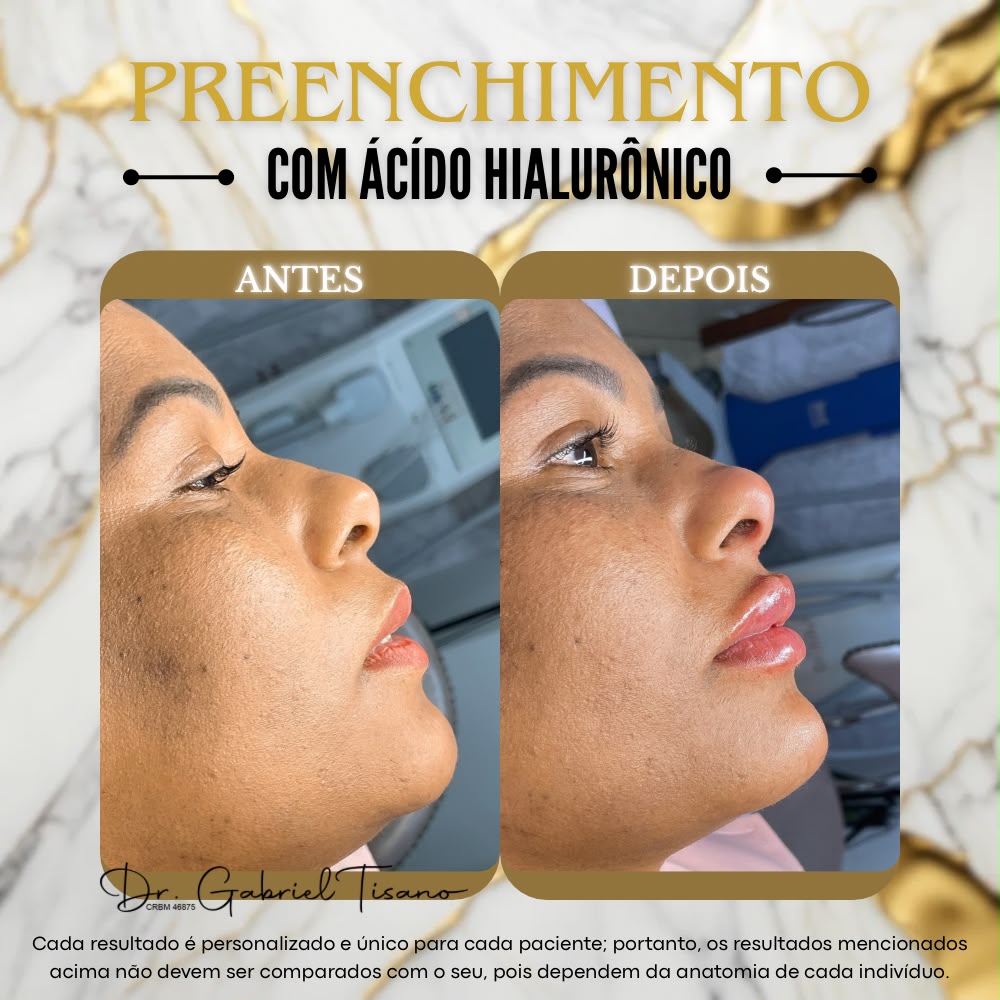 Definição de Mandíbula Antes e Depois - Clínica Elevation