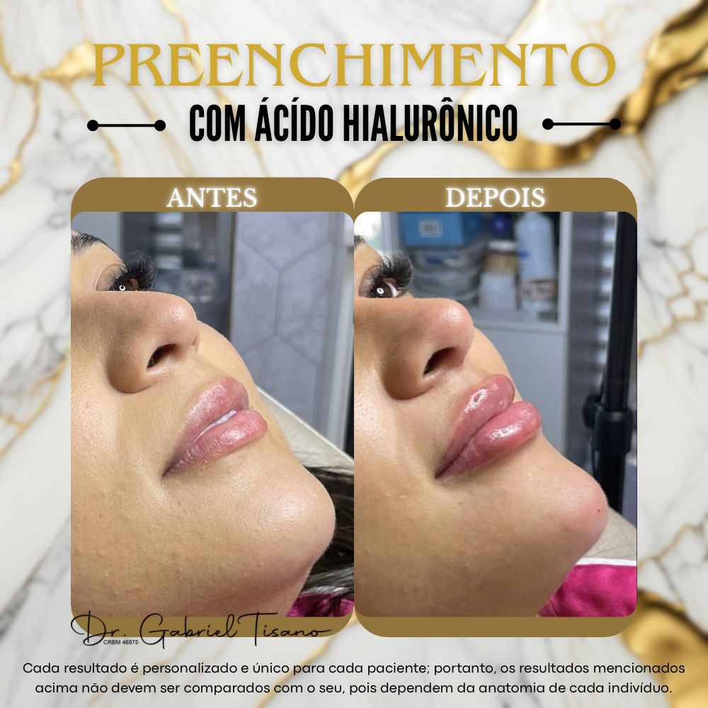 Antes e Depois - Preenchimento com Ácido Hialurônico - Dr. Gabriel Tisano
